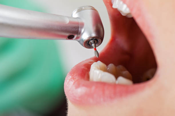Best Emergency Wisdom Teeth Removal in Williamstown, KY